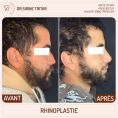 Rhinoplastie - Cliché avant - Dr Sirine Tritar