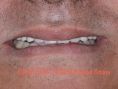 Implants dentaires - Cliché avant