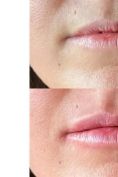 Augmentation des lèvres - Cliché avant - Dr Bertrand Joly