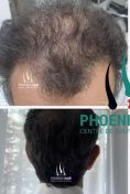 Greffe de cheveux - Cliché avant - Phoenix Hair Center