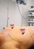 Augmentation mammaire (Implants mammaires) - Cliché avant - Dr Achraf Daoud