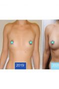 Lipofilling mammaire - Cliché avant - Dr Laurent Benadiba M.D