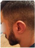 Otoplastie (Chirurgie esthétique des oreilles) - Cliché avant - Docteur Hayet Zitoun Esthétique