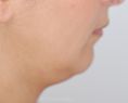 Chirurgie du double-menton - La lipoaspiration du cou à l