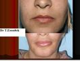 Augmentation des lèvres (injection de graisse) - Cliché avant - Dr Tayeb Essadok