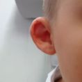 Otoplastie (Chirurgie esthétique des oreilles) - Cliché avant - Docteur Anne-Sophie Hue