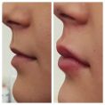 Augmentation des lèvres - Cliché avant - Dr Michael Atlan