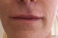 Augmentation des lèvres (acide hyaluronique) - Ourlet et augmentation légère de volume des lèvres supérieure et inférieure par injection de 0,55ml d’acide hyaluronique à la canule