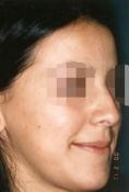 Rhinoplastie - Cliché avant - Dott. Andrea La Padula M.D.