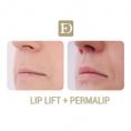 Augmentation des lèvres par Permalip - Cliché avant - Dr Franck Ouakil