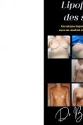 Lifting des seins avec implants - Cliché avant - Dr Laurent Benadiba M.D