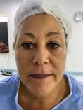 Dr. Gherissi Anas - Résultat à deux mois après lifting du visage et blepharoplastie supérieure et inférieure.