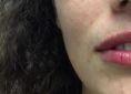 Augmentation des lèvres (acide hyaluronique) - Cliché avant - Dr Joseph Rebot