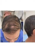 Greffe de cheveux - Cliché avant - Dr Laurent Benadiba M.D