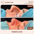 Rhinoplastie - Cliché avant - Dr Sirine Tritar