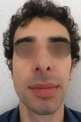 Chirurgie du double-menton - Cliché avant - Dr Fabrice Poirier