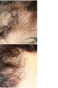 Greffe de cheveux - Cliché avant - Dr Alain Berkovits