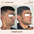 Rhinoplastie - Cliché avant - Dr Sirine Tritar