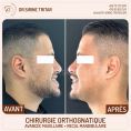 Chirurgie réparatrice du visage - Cliché avant - Dr Sirine Tritar