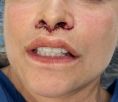 Augmentation des lèvres - Le Lift lips est une technique simple pour remonter la lèvre et donner plus de volume sans injection.