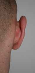 Otoplastie (Chirurgie esthétique des oreilles) - Cliché avant - Dr Christelle Santini