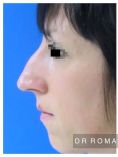 Génioplastie - Chirurgie esthétique du menton - Rhinoplastie de pointe et bosse : Résultat à 1 an de profil. À noter une génioplastie par transfert graisseux (au niveau du menton).