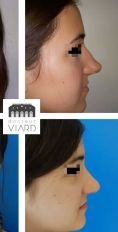 Septoplastie (opération de la cloison nasale) - Cliché avant - Dr Romain Viard