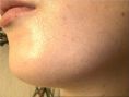 Traitement acné - laser - Cliché avant - Dr Christine Luneau