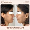 Chirurgie réparatrice du visage - Cliché avant - Dr Sirine Tritar