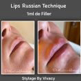 Augmentation des lèvres - Injection 1ml de Filler