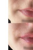 Augmentation des lèvres - Cliché avant - Dr Bertrand Joly