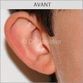 Otoplastie (Chirurgie esthétique des oreilles) - Cliché avant - Dr Henry Sabatier