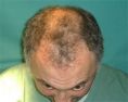 Traitements de la chute des cheveux - Cliché avant - Dr Gérard  COUREAU