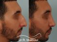 Rhinoplastie - Correction de la bosse importante et de la déviation majeure du nez.