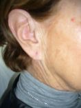 Otoplastie (Chirurgie esthétique des oreilles) - Cliché avant - Dr Laurent Benadiba M.D