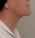 Chirurgie du double-menton - Cliché avant - RS Esthétique - Centre d’amincissement & remodelage de la silhouette anti-âge visage et corps sans chirurgie