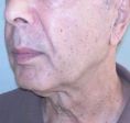Lifting du visage - Cliché avant - Dr Christian Berwald