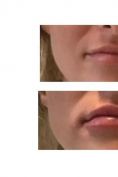 Augmentation des lèvres (acide hyaluronique) - Cliché avant - Dr Alexandre Krassoulia-Vronsky