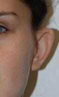 Otoplastie (Chirurgie esthétique des oreilles) - Les oreilles décollées sont souvent dues à l