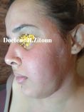 Docteur Hayet Zitoun Esthétique - La patiente a bénéficié de séances de PRP
Full filler face remodelage par lipodissolution