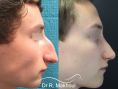 Rhinoplastie - Ablation de la très volumineuse bosse, correction de la pointe tombante, correction de la déviation importante de la cloison nasale.