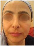 Lifting du visage - Cliché avant - Docteur Hayet Zitoun Esthétique