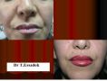 Augmentation des lèvres (injection de graisse) - Cliché avant