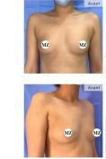 Augmentation mammaire (Implants mammaires) - Cliché avant - Professeur Mourad Zinelabidine