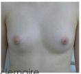 Lipofilling mammaire - Cliché avant - Dr Thierry Lemaire