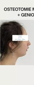 Génioplastie - Chirurgie esthétique du menton - Cliché avant - Dr Frédéric Barere
