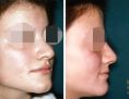 Rhinoplastie - Cliché avant - Dott. Andrea La Padula M.D.