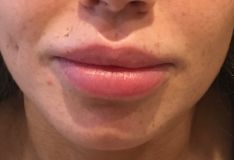 Dr Raphaële Rossarie - Embellissement de l’ourlet des lèvres supérieure et inférieure à la canule et hydratation par 1,2ml d’acide hyaluronique