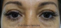 Dr Thierry Lemaire - Résultat d’un lipofilling chez une patiente présentant des cernes dus à des poches sous les yeux peu importantes.
