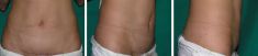 Abdominoplastie - Cliché avant - Dott. Andrea La Padula M.D.